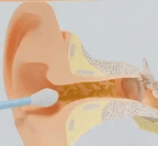 🧼👂 Smart ørerenser – Avansert teknologi for renere og tryggere ører! (8-delers sett)