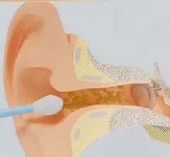 🧼👂 Smart ørerenser – Avansert teknologi for renere og tryggere ører! (8-delers sett)