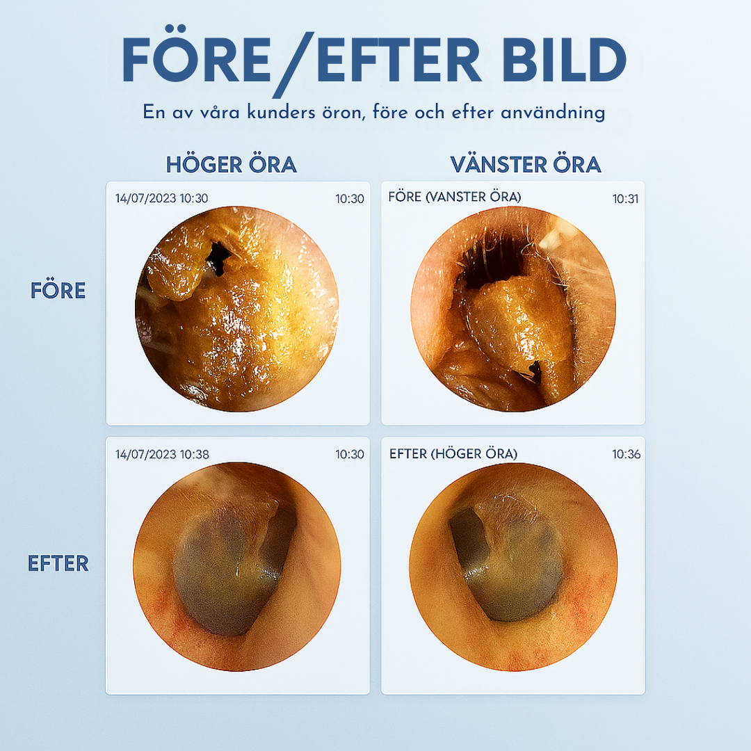 🧼👂 Smart ørerenser – Avansert teknologi for renere og tryggere ører! (8-delers sett)